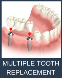 All on 4 Dental implants