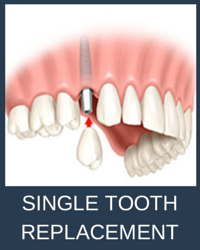 dental implant single tooth